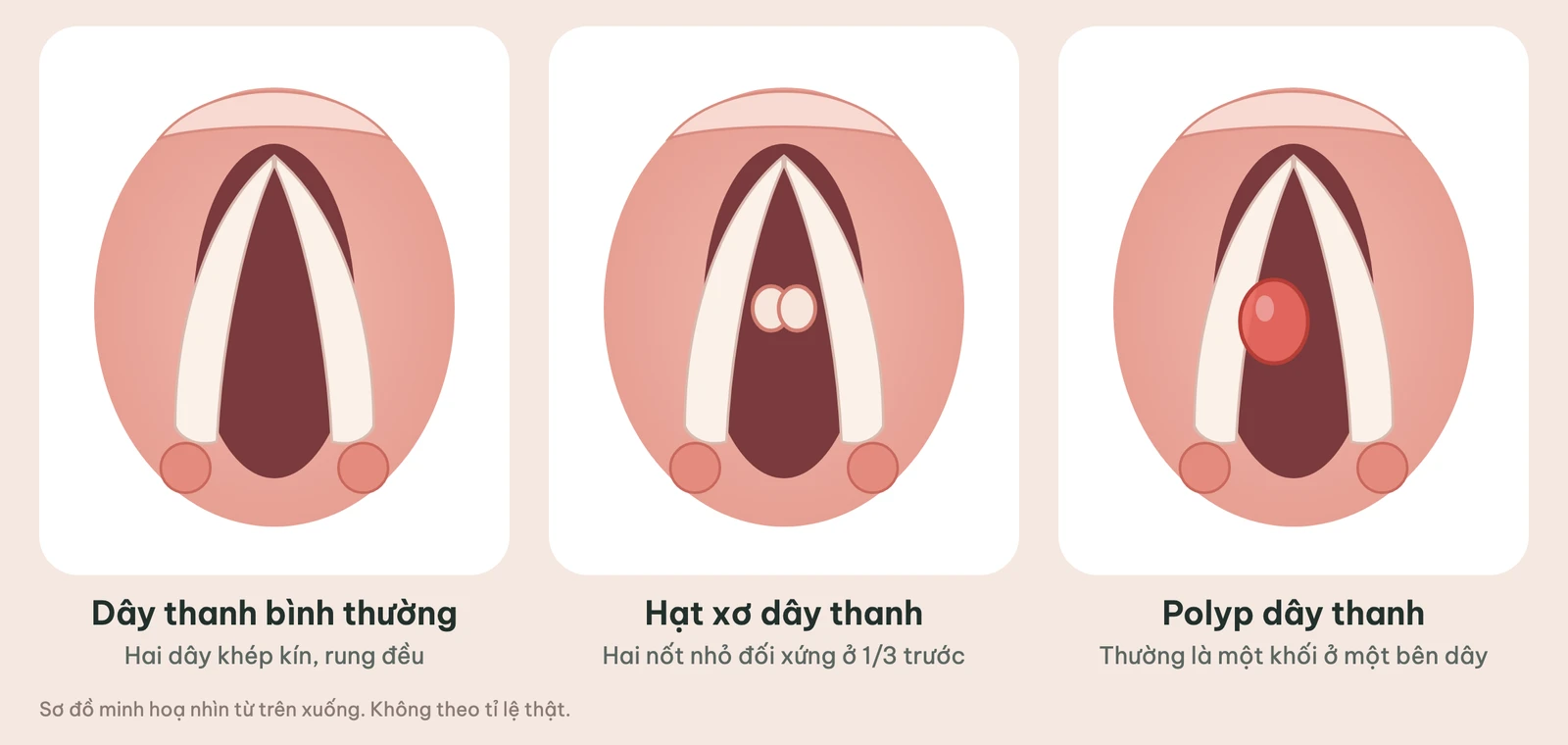 Sơ đồ so sánh dây thanh bình thường, dây thanh có hạt xơ hai bên và dây thanh có một polyp