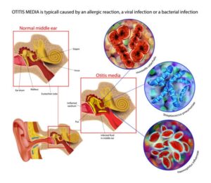 Read more about the article Nguyên nhân gây viêm tai giữa cấp ở trẻ em: Hiểu đúng để phòng ngừa sớm