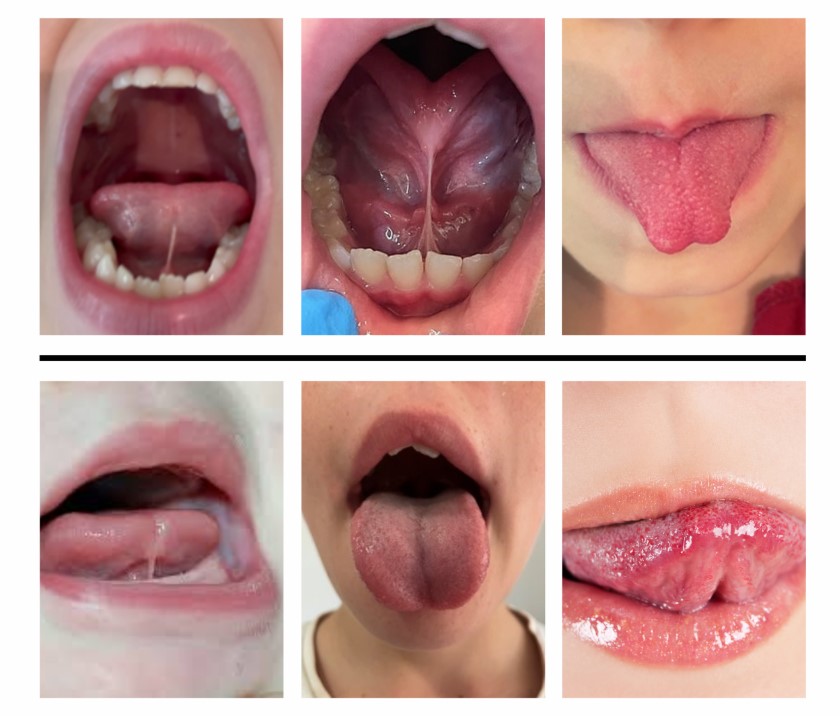 Read more about the article Cắt thắng lưỡi cho trẻ nhỏ có cần thiết không? Hiểu đúng và đủ – BS Đức Nha Trang